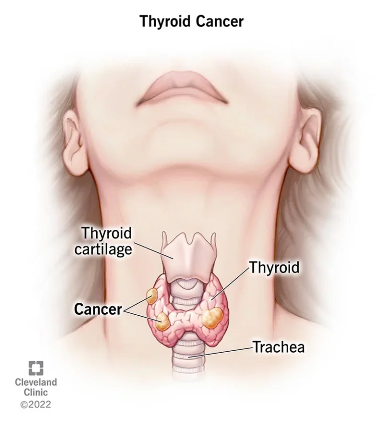 Thyroid cancer