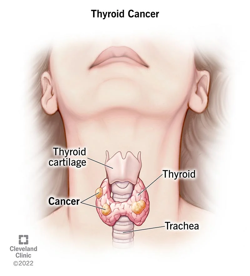 Thyroid cancer:Meet The Hidden Killer