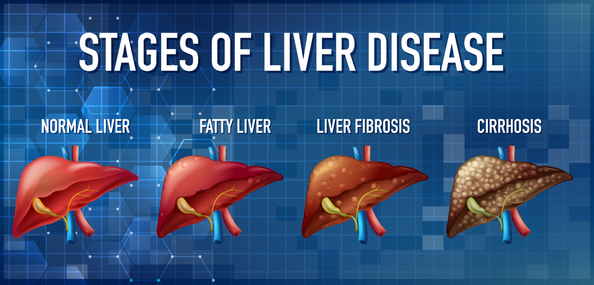 Liver Failure:Detecting Early Signs will save your life.